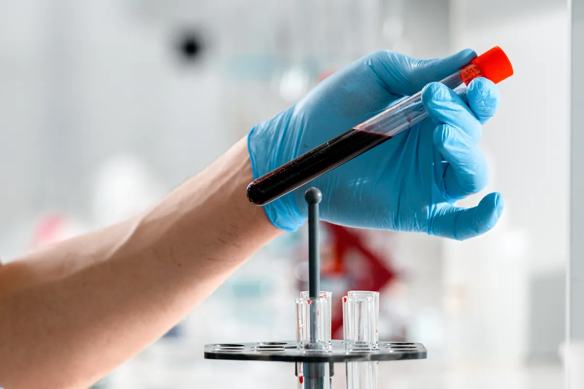 A researcher examining a blood sample in a clinical laboratory